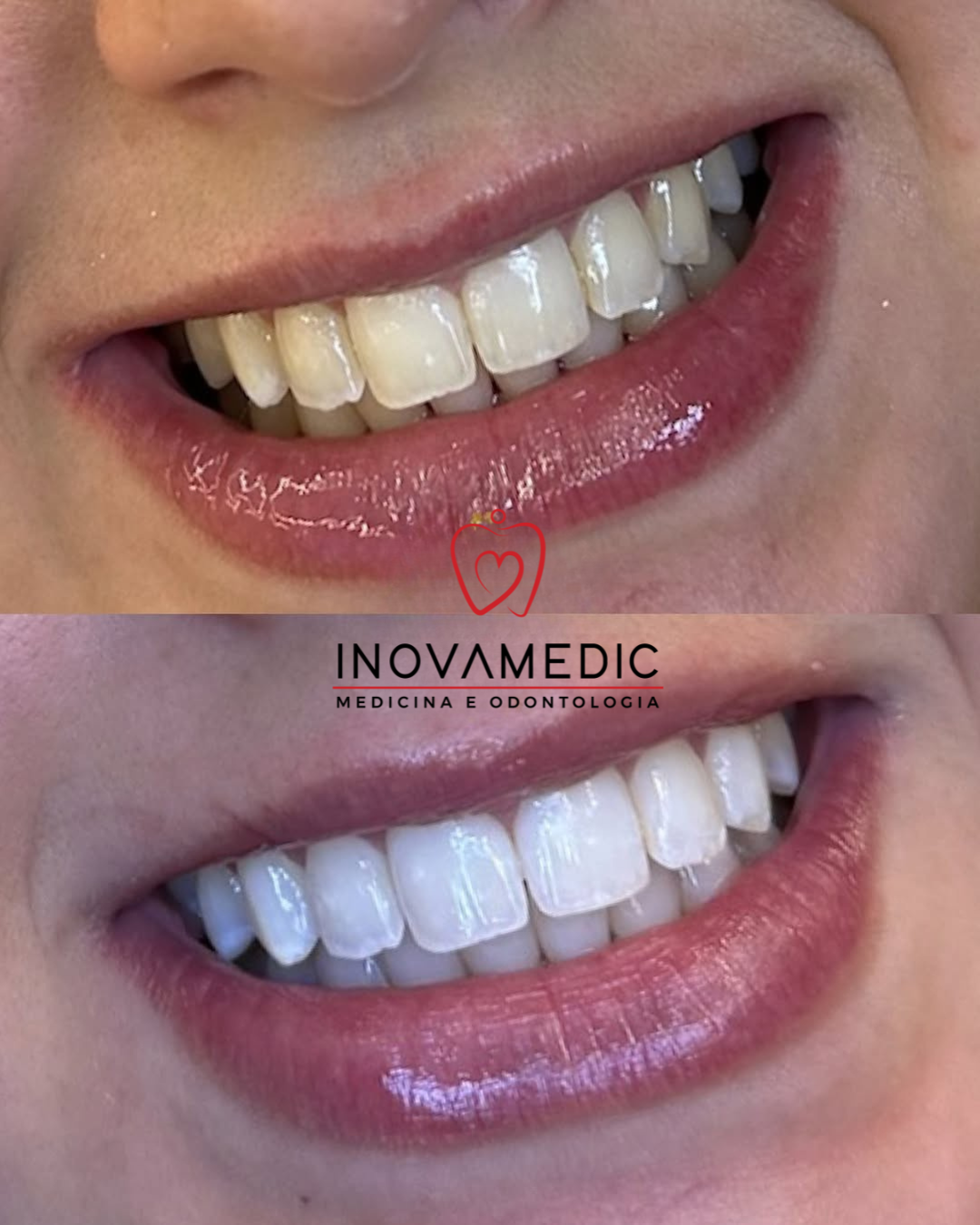 Reabilitação estética — caso B
